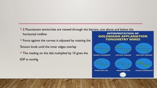 2 Fluorescent semicircles are viewed through the biprism, one above and below the
horizontal midline
Force against the cornea is adjusted by rotating the
Tension knob until the inner edges overlap
The reading on the dial multiplied by 10 gives the
IOP in mmHg
 