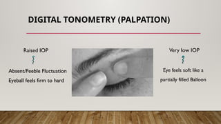 DIGITAL TONOMETRY (PALPATION)
Raised IOP Very low IOP
Absent/Feeble Fluctuation
Eyeball feels firm to hard
Eye feels soft like a
partially filled Balloon
 