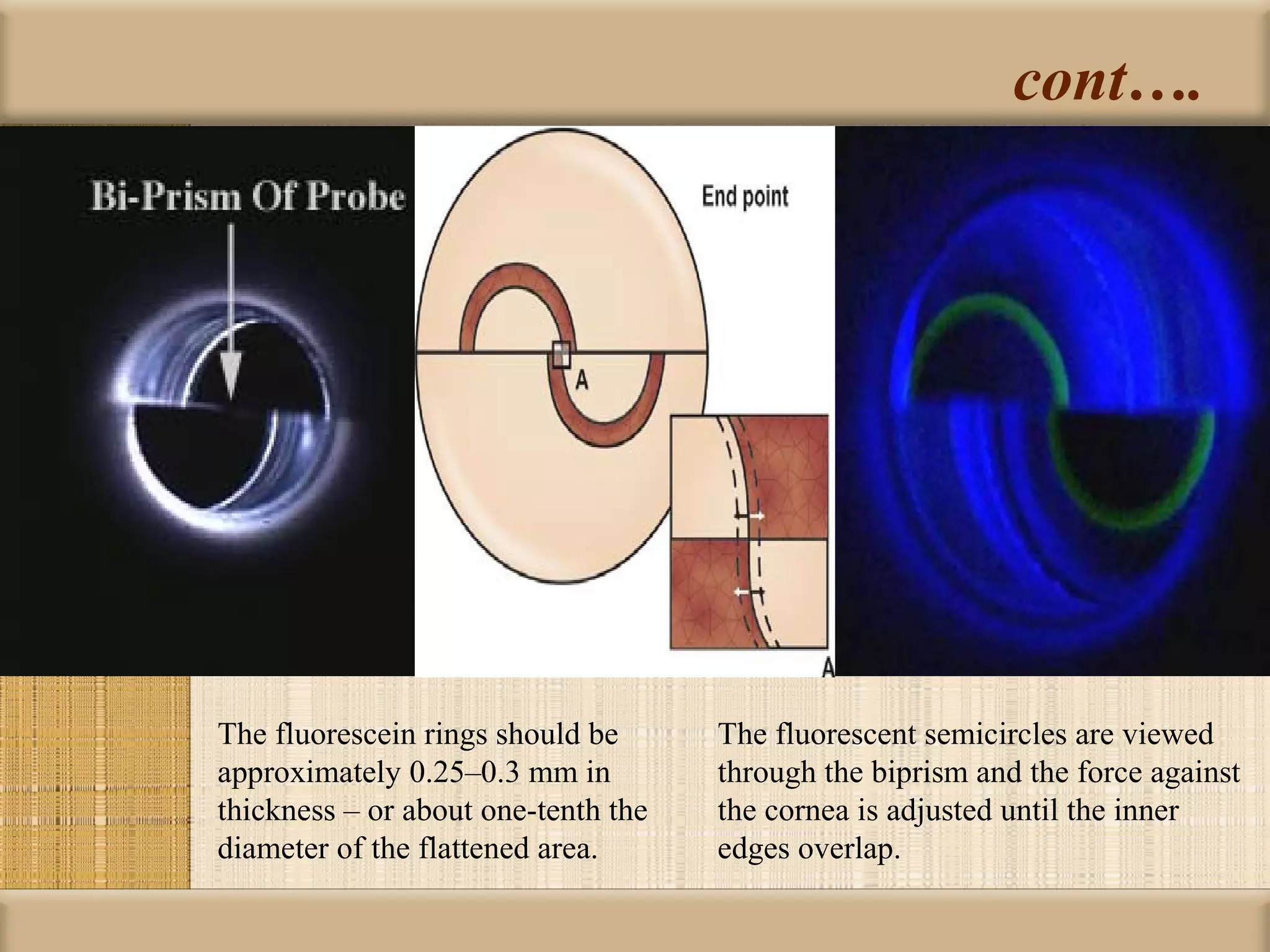 cont….




The fluorescein rings should be      The fluorescent semicircles are viewed
approximately 0.25–0.3 mm in         through the biprism and the force against
thickness – or about one-tenth the   the cornea is adjusted until the inner
diameter of the flattened area.      edges overlap.
 