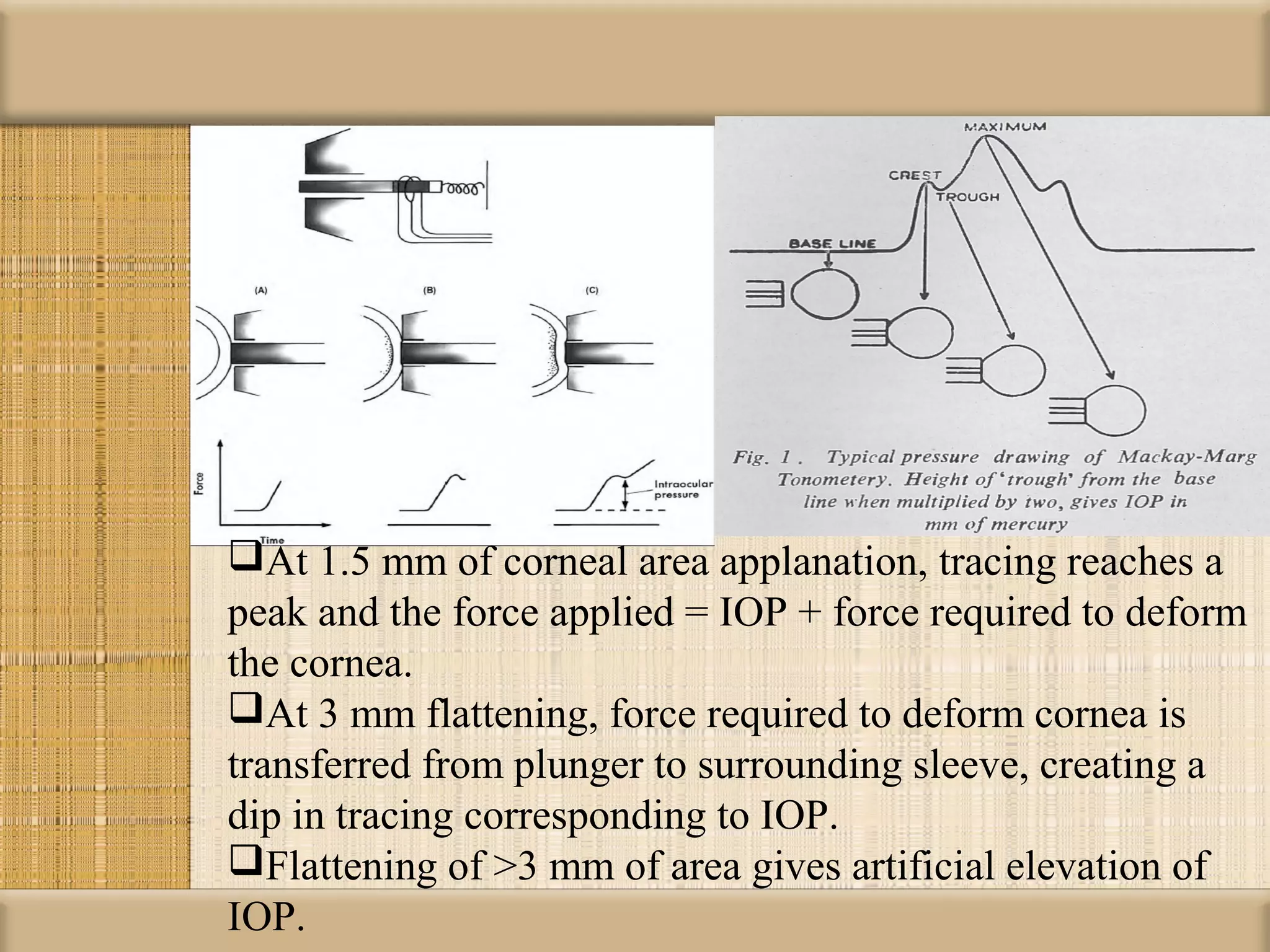 At 1.5 mm of corneal area applanation, tracing reaches a
peak and the force applied = IOP + force required to deform
the cornea.
At 3 mm flattening, force required to deform cornea is
transferred from plunger to surrounding sleeve, creating a
dip in tracing corresponding to IOP.
Flattening of >3 mm of area gives artificial elevation of
IOP.
 