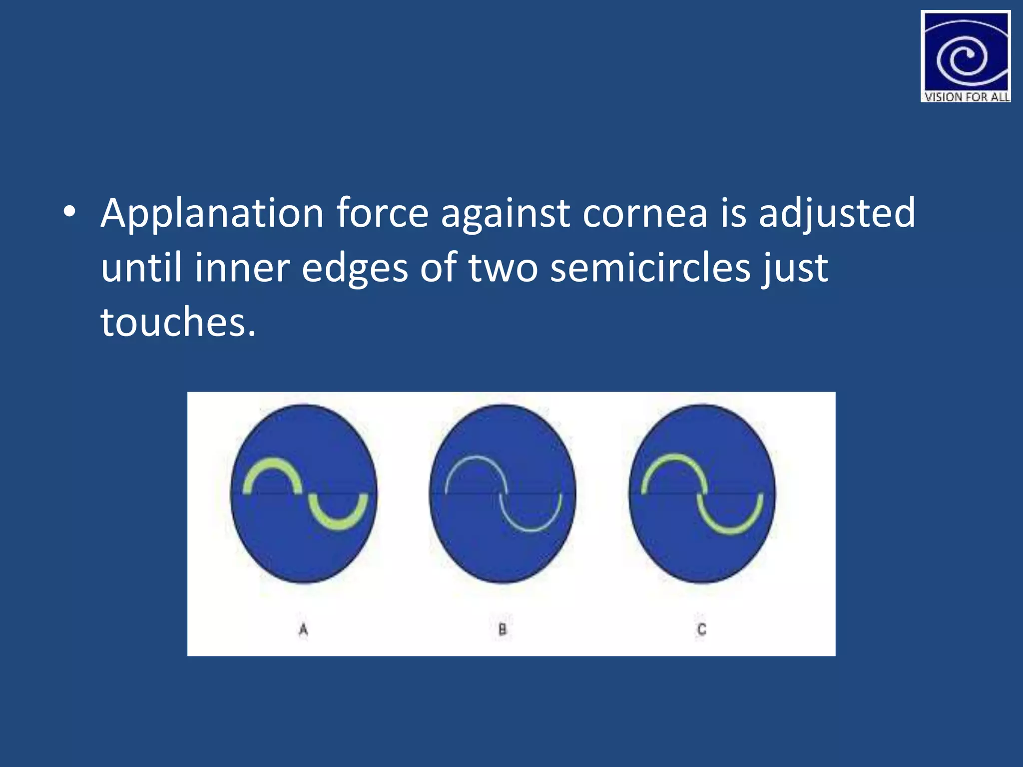 • Applanation force against cornea is adjusted
until inner edges of two semicircles just
touches.
 