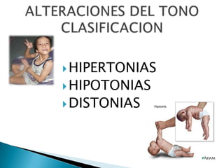  HIPERTONIAS
 HIPOTONIAS
 DISTONIAS

 