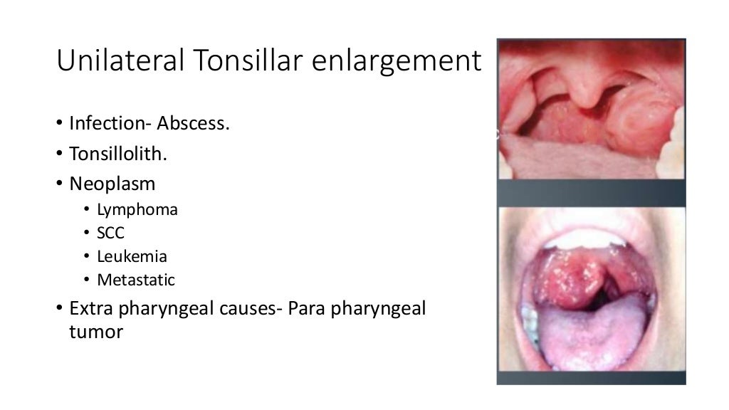 Tonsilar disease