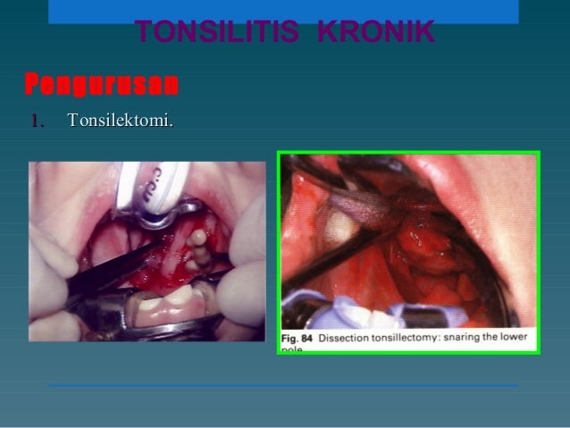 TONSILITIS