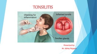 TONSILITIS
Presented by:
Mr. Abhay Rajpoot
 