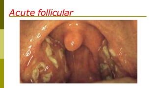 Acute follicular
 