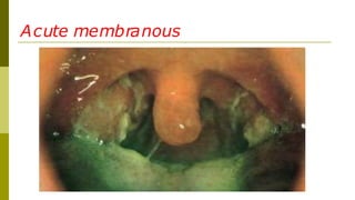 Acute membranous
 