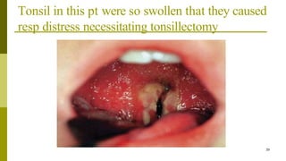 Tonsil in this pt were so swollen that they caused
resp distress necessitating tonsillectomy
39
 