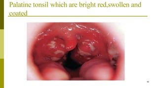 Palatine tonsil which are bright red,swollen and
coated
40
 