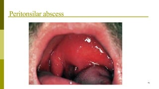 Peritonsilar abscess
41
 