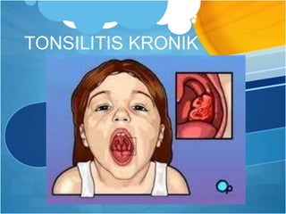 TONSILITIS KRONIK
 