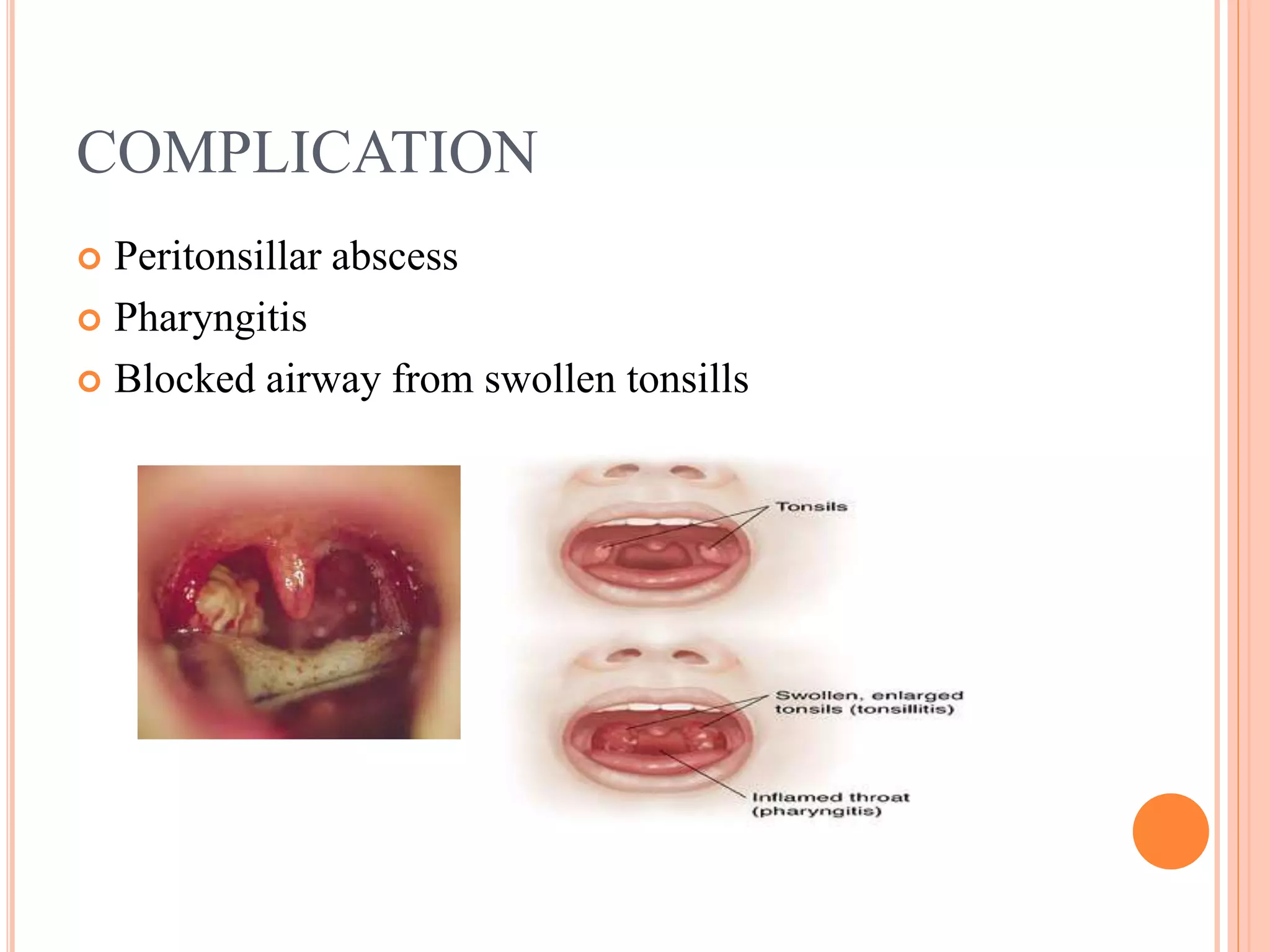 tonsilitis-ppt-1-pptx