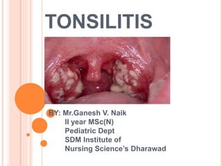 TONSILITIS
BY: Mr.Ganesh V. Naik
II year MSc(N)
Pediatric Dept
SDM Institute of
Nursing Science’s Dharawad
 