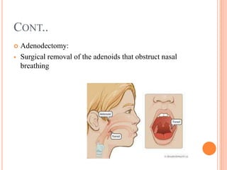 CONT..
 Adenodectomy:
 Surgical removal of the adenoids that obstruct nasal
breathing
 