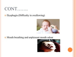 CONT…….
 Dysphagia (Difficulty in swallowing)
 Mouth breathing and unpleasant mouth odour
 