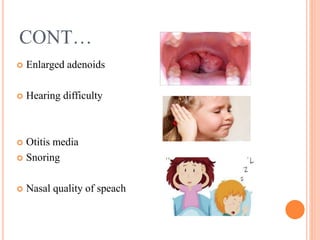 CONT…
 Enlarged adenoids
 Hearing difficulty
 Otitis media
 Snoring
 Nasal quality of speach
 