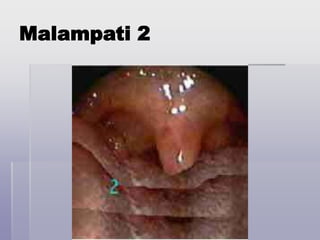 Malampati 2
 