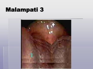 Malampati 3
 