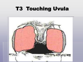 T3 Touching Uvula
 