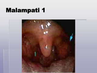 Malampati 1
 