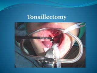 Tonsillectomy
 