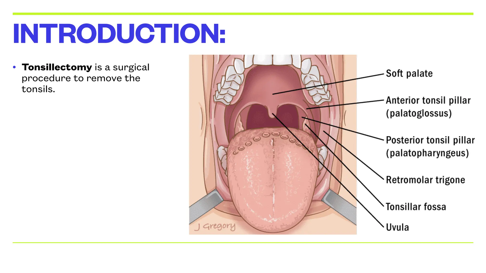 Tonsillectomy: Surgical Removal of Tonsils | PPT