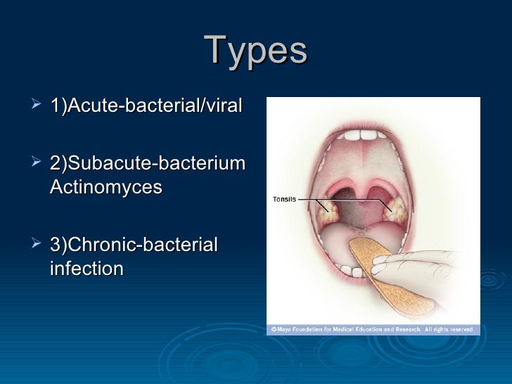 Tonsillitis