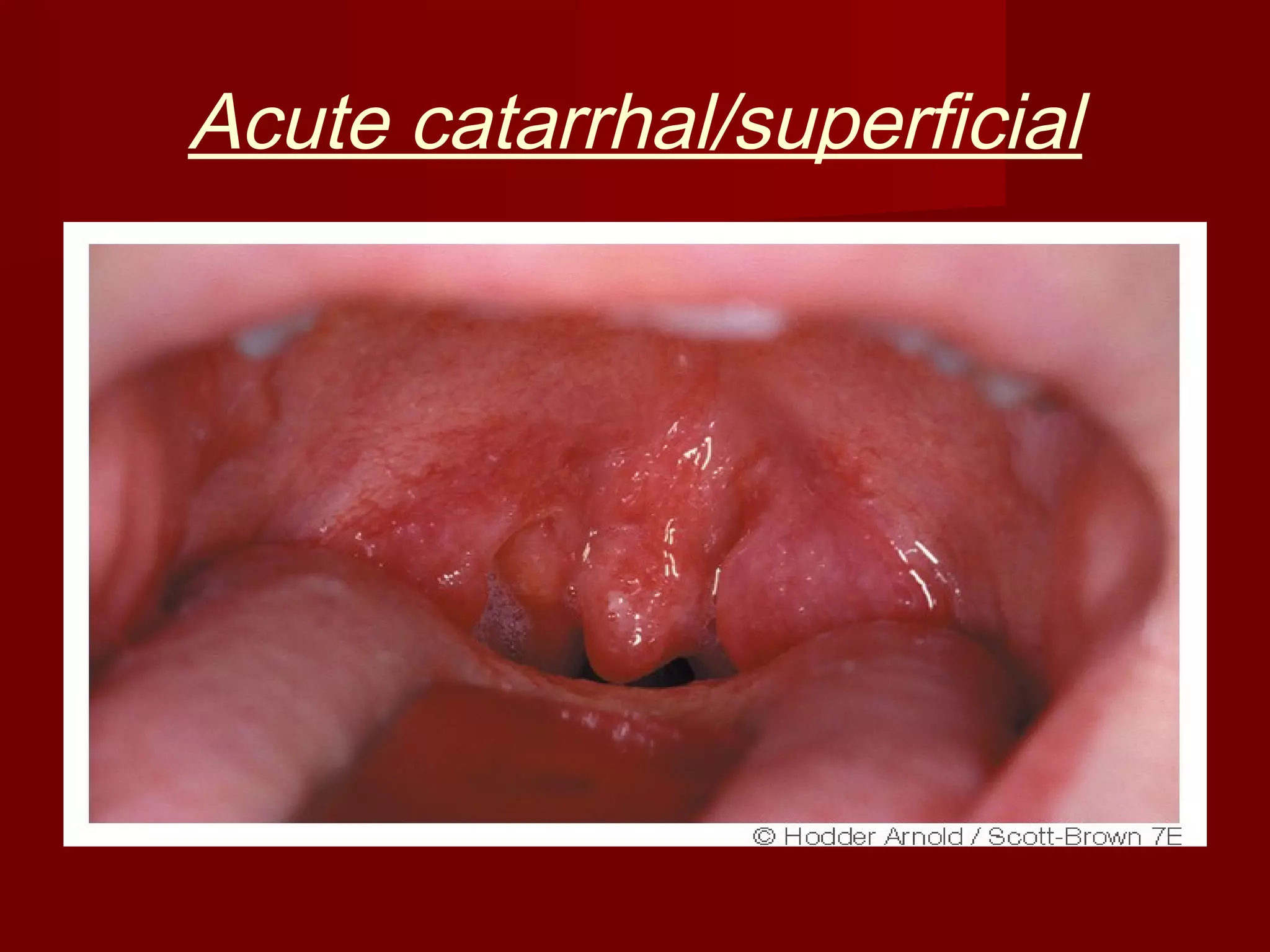 Acute catarrhal/superficial
 