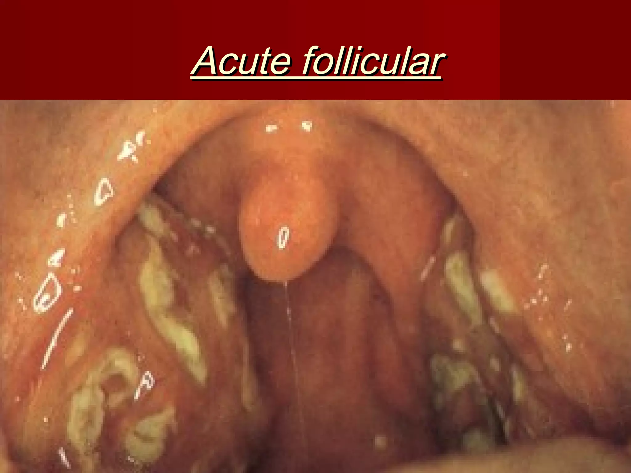 Acute follicular
 