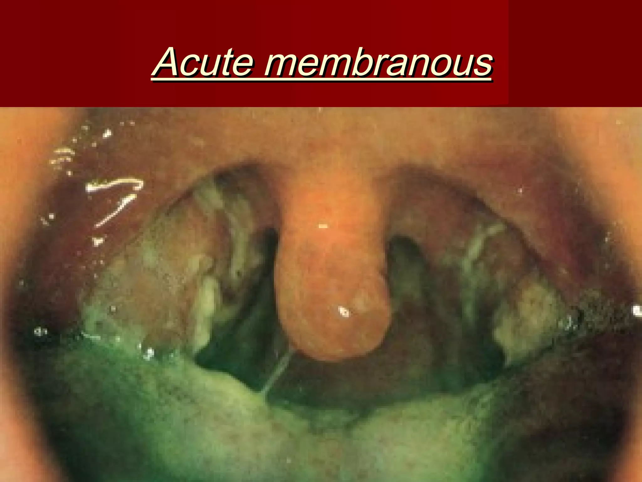 Acute membranous
 