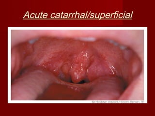 Acute catarrhal/superficial
 