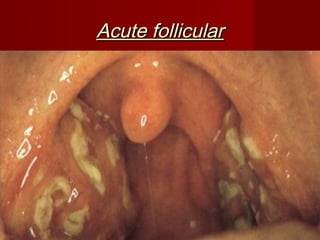 Acute follicular
 