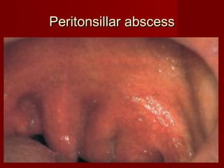 Peritonsillar abscess
 