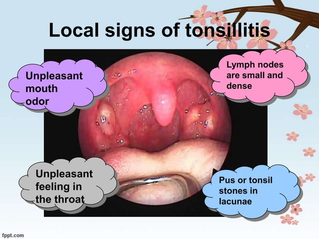 Tonsillitis.in children