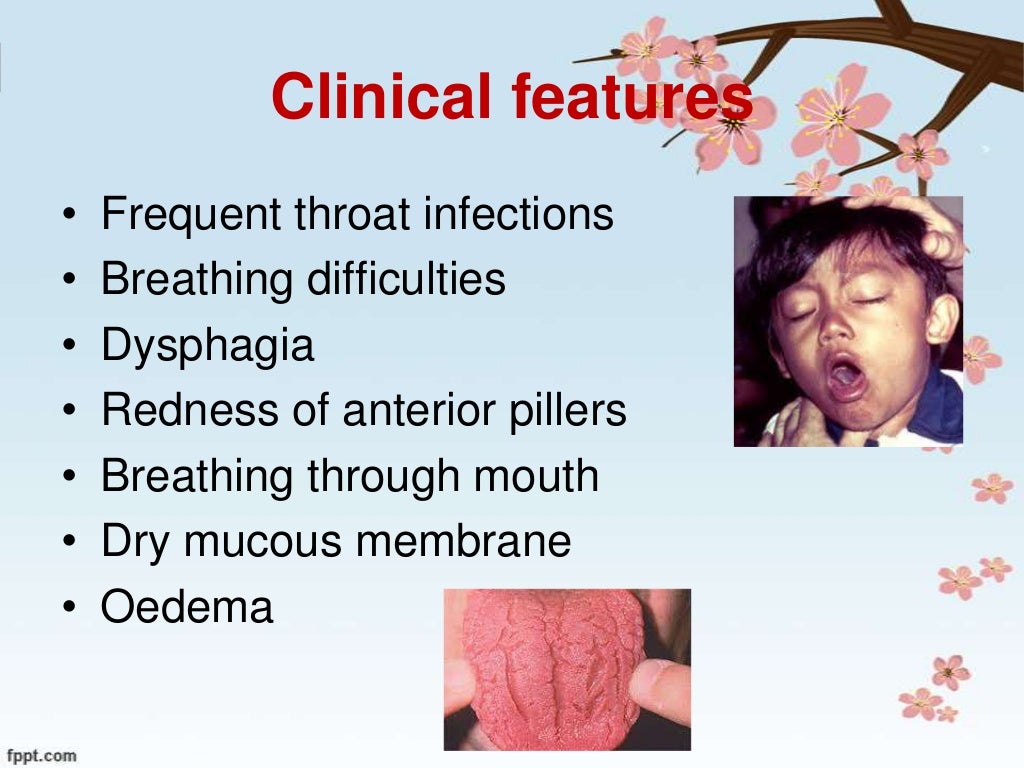 Tonsillitis.in children