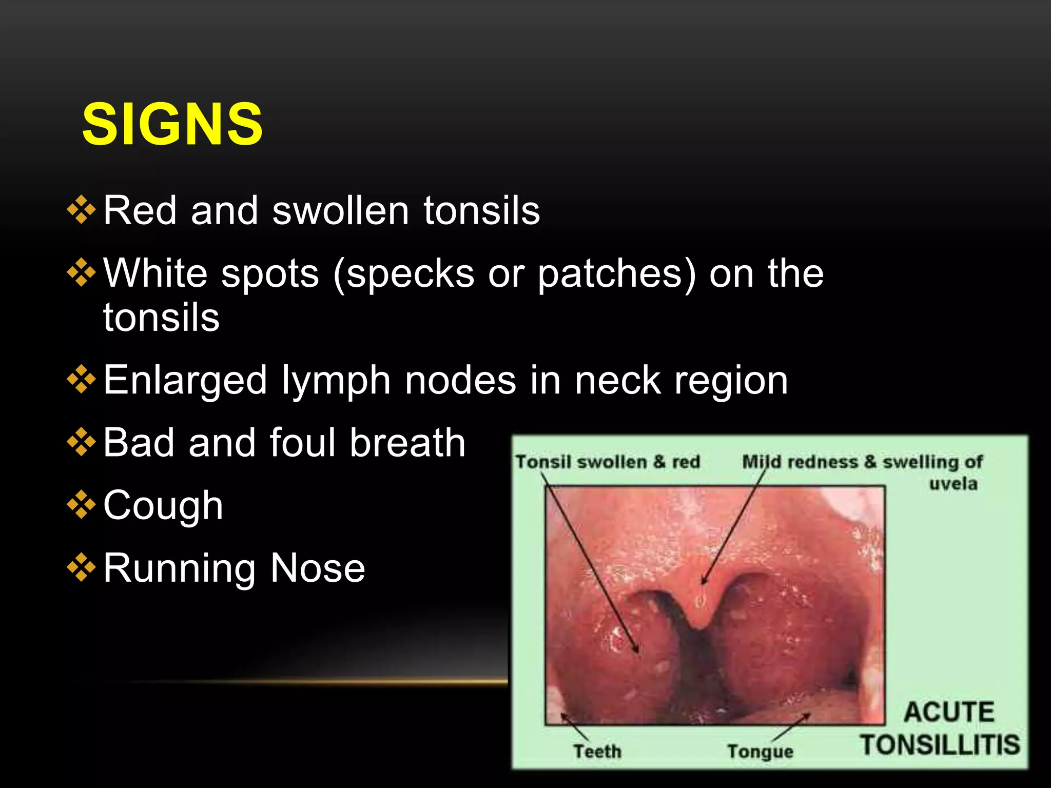 SIGNS 
Red and swollen tonsils 
White spots (specks or patches) on the 
tonsils 
Enlarged lymph nodes in neck region 
Bad and foul breath 
Cough 
Running Nose 
 