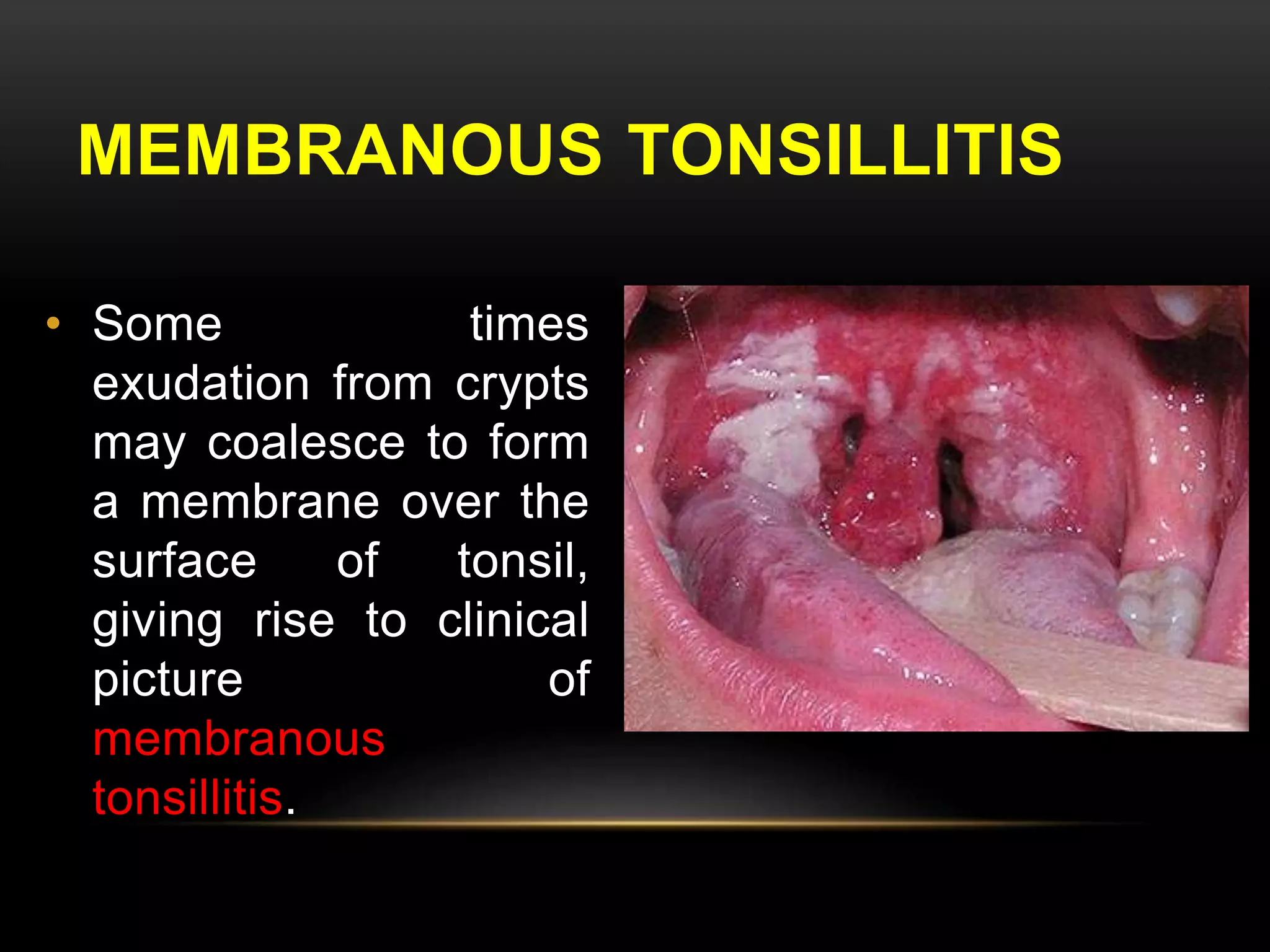 MEMBRANOUS TONSILLITIS 
• Some times 
exudation from crypts 
may coalesce to form 
a membrane over the 
surface of tonsil, 
giving rise to clinical 
picture of 
membranous 
tonsillitis. 
 