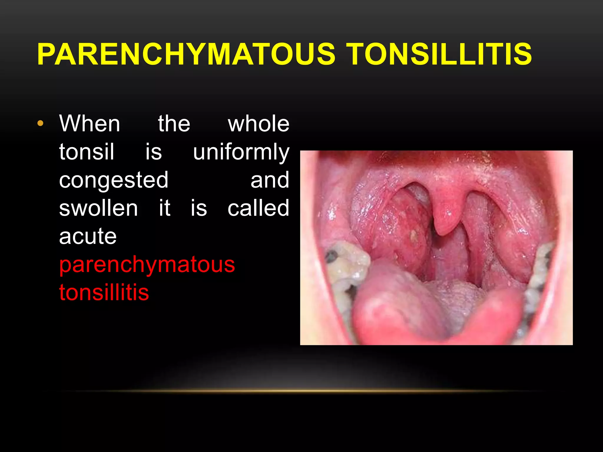 PARENCHYMATOUS TONSILLITIS 
• When the whole 
tonsil is uniformly 
congested and 
swollen it is called 
acute 
parenchymatous 
tonsillitis 
 