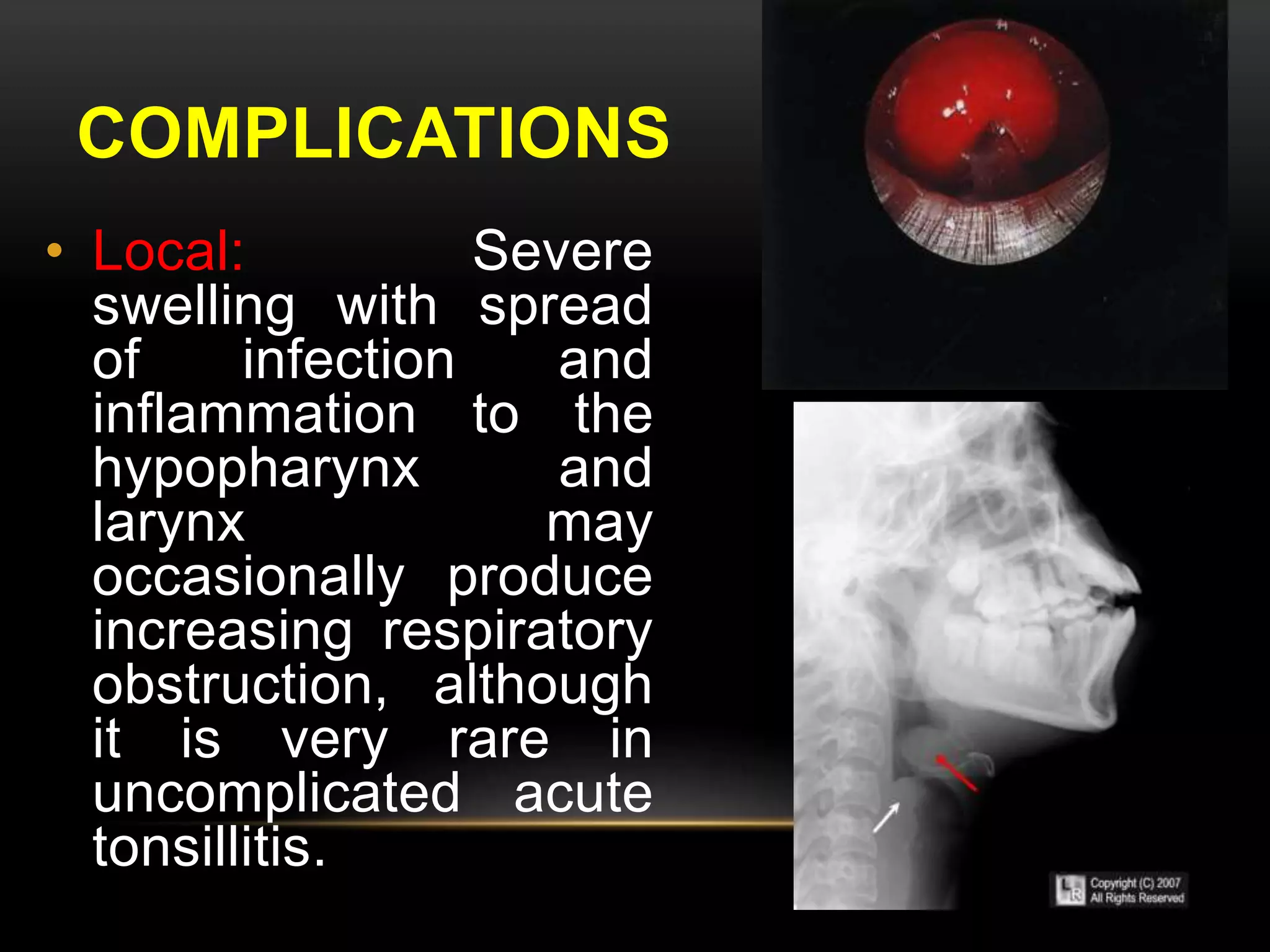 COMPLICATIONS 
• Local: Severe 
swelling with spread 
of infection and 
inflammation to the 
hypopharynx and 
larynx may 
occasionally produce 
increasing respiratory 
obstruction, although 
it is very rare in 
uncomplicated acute 
tonsillitis. 
 