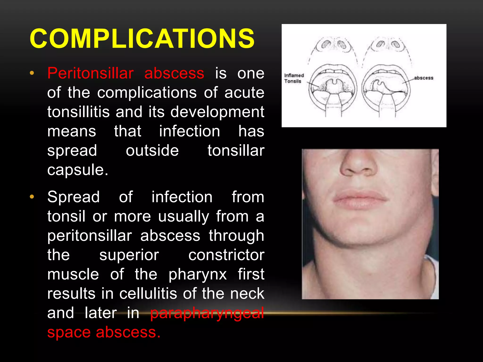 COMPLICATIONS 
• Peritonsillar abscess is one 
of the complications of acute 
tonsillitis and its development 
means that infection has 
spread outside tonsillar 
capsule. 
• Spread of infection from 
tonsil or more usually from a 
peritonsillar abscess through 
the superior constrictor 
muscle of the pharynx first 
results in cellulitis of the neck 
and later in parapharyngeal 
space abscess. 
 