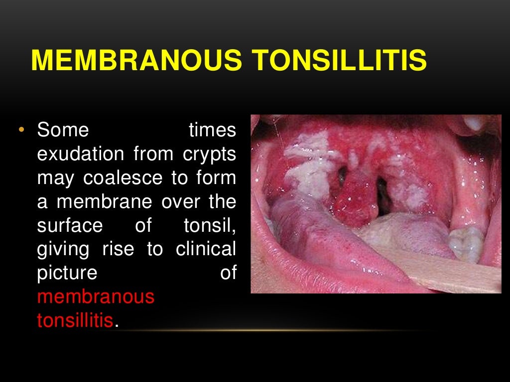 tonsillitis