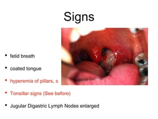 Signs
• fetid breath
• coated tongue
• hyperemia of pillars, soft palate, uvula
• Tonsillar signs (See before)
• Jugular Digastric Lymph Nodes enlarged
 
