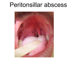 Peritonsillar abscess
 