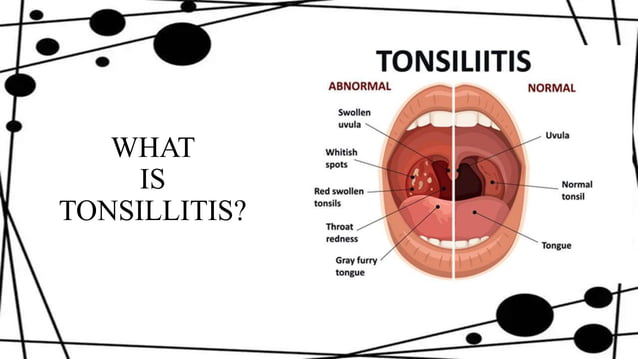 Tonsillitis.pptx
