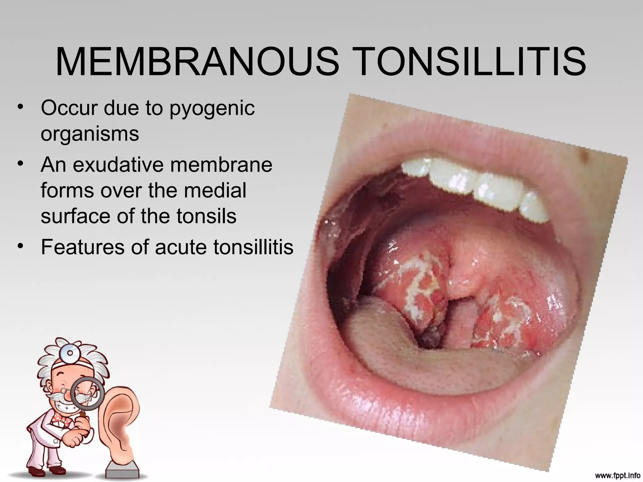 MEMBRANOUS TONSILLITIS
• Occur due to pyogenic
organisms
• An exudative membrane
forms over the medial
surface of the tonsils
• Features of acute tonsillitis
 