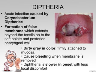DIPTHERIA
• Acute infection caused by
Corynebacterium
Diptheriae
• Formation of false
membrane which extends
beyond the tonsils on to the
soft palate and posterior
pharyngeal wall.
• Dirty gray in color, firmly attached to
mucosa.
• Cause bleeding when membrane is
removed
• Diphtheria is slower in onset with less
local discomfort
 