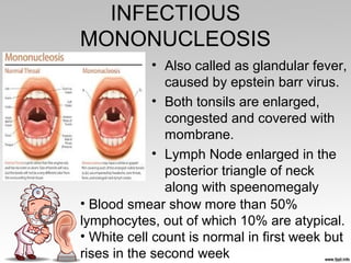 INFECTIOUS
MONONUCLEOSIS
• Also called as glandular fever,
caused by epstein barr virus.
• Both tonsils are enlarged,
congested and covered with
mombrane.
• Lymph Node enlarged in the
posterior triangle of neck
along with speenomegaly
• Blood smear show more than 50%
lymphocytes, out of which 10% are atypical.
• White cell count is normal in first week but
rises in the second week
 