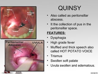 QUINSY
• Also called as peritonsillar
abscess.
• It the collection of pus in the
peritonsillar space.
FEATURES:
• Dysphagia
• High grade fever
• Muffled and thick speech also
called HOT POTATO VOICE
• Trismus
• Swollen soft palate
• Uvula swollen and edematous.
 