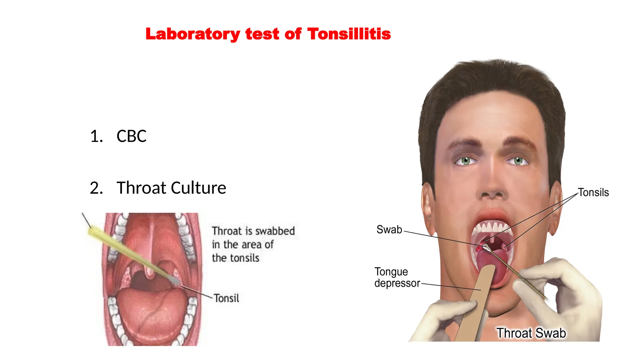 tonsillitis-guyhhfhjhgfhhhgggyjjhghjhhggh-ppt-free-download