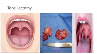 Tonsillectomy
 